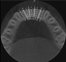 Foto Reproducibility of cone-beam computed tomographic measurements of bone plates and the interdental septum in the anterior mandible